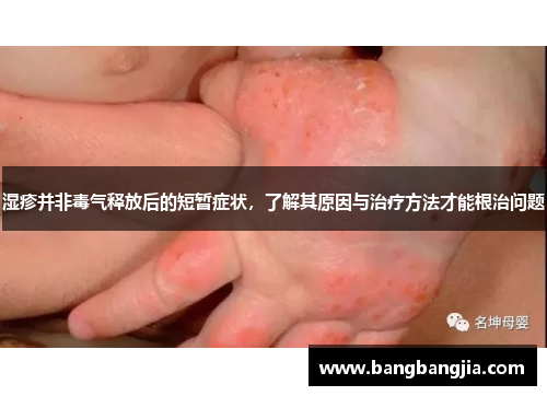 湿疹并非毒气释放后的短暂症状，了解其原因与治疗方法才能根治问题